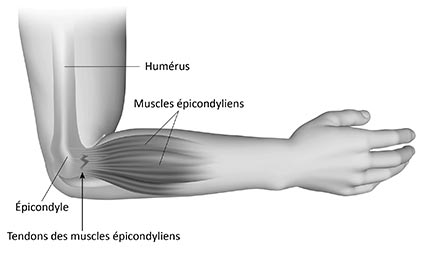 Épicondylite